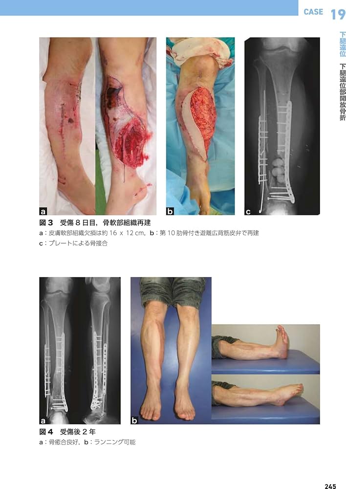 重度四肢外傷治療の奥義 | 土田芳彦 |本 | 通販 | Amazon